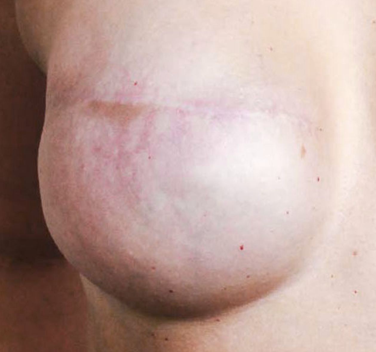 Melissa Wefers Pigmentistin Oberhausen 3dareola prothetik ergebnis vorher b