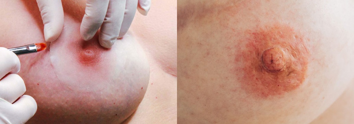 Melissa Wefers Oberhausen Wesel 3D Areola Prothetik Medizinische Brustwarzentaetowierung
