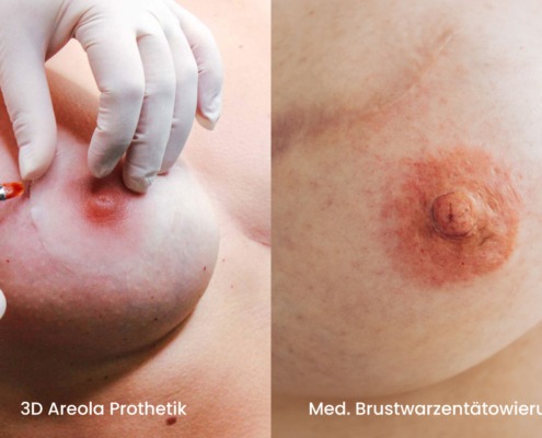 Melissa Wefers Oberhausen Wesel 3D Areola Prothetik Medizinische Brustwarzentaetowierung