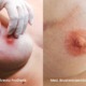 Melissa Wefers Oberhausen Wesel 3D Areola Prothetik Medizinische Brustwarzentaetowierung