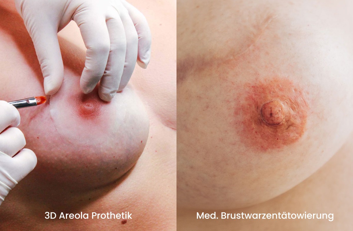 Melissa_Wefers_Oberhausen_Areola-Prothetik Melissa_Wefers_Oberhausen_Areola-Prothetik